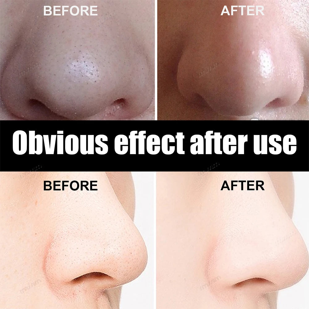 Blackhead Removal Mask Peel Deep Cleansing